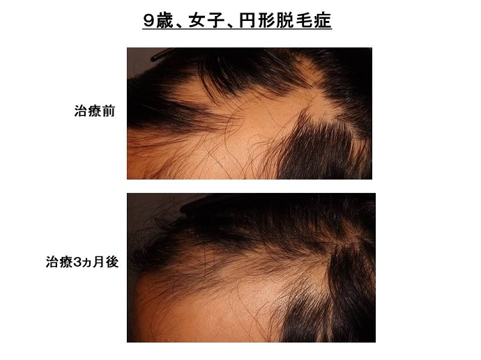 円形脱毛症　病院""